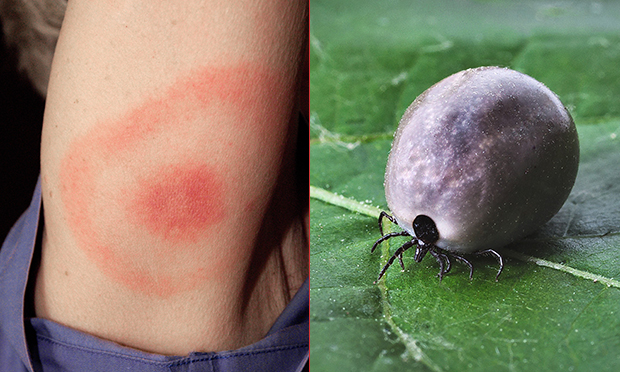 Woman Catches Lyme Disease From Tick Bite At Clissold Park Say 